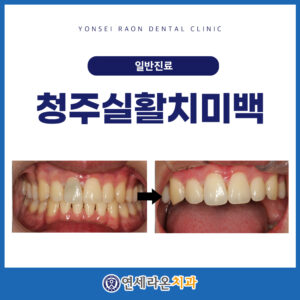 청주실활치미백