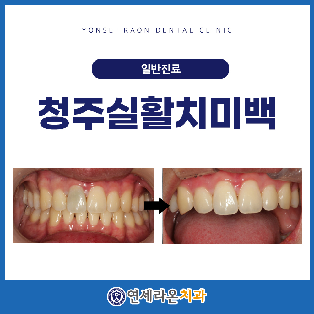 청주실활치미백
