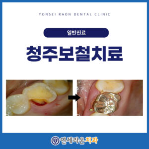 청주보철치료