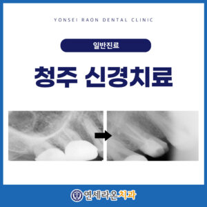 청주신경치료