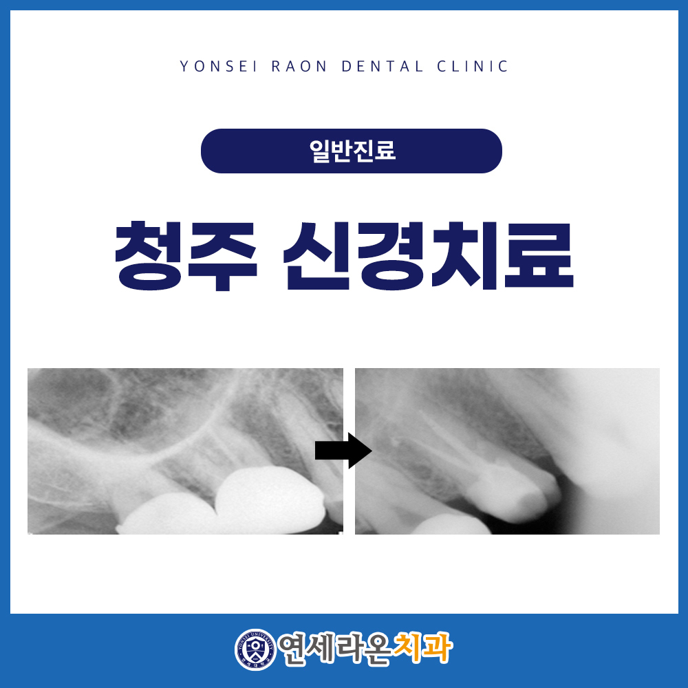 청주신경치료