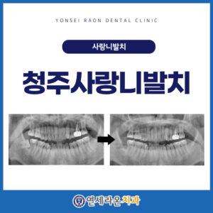 청주사랑니발치