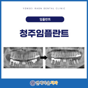 청주임플란트