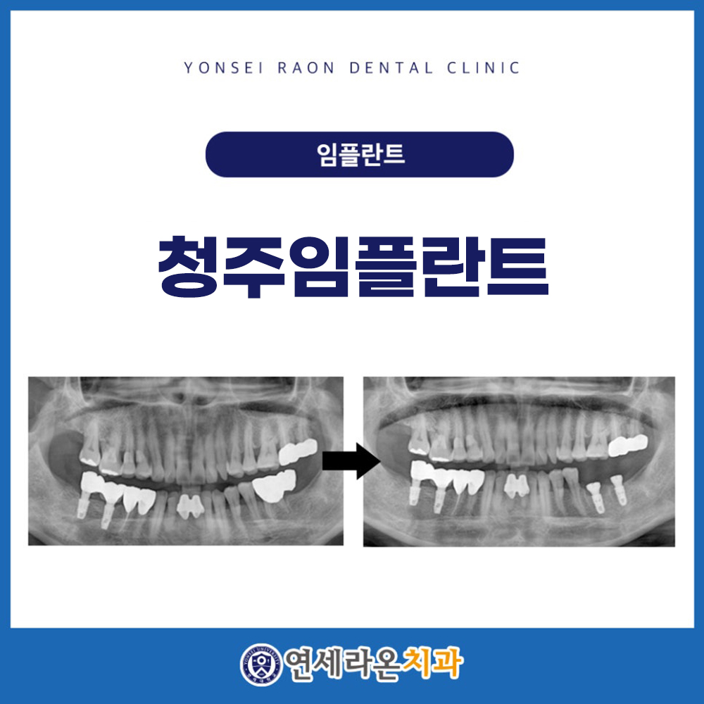 청주임플란트
