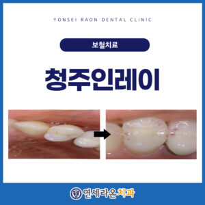 청주인레이