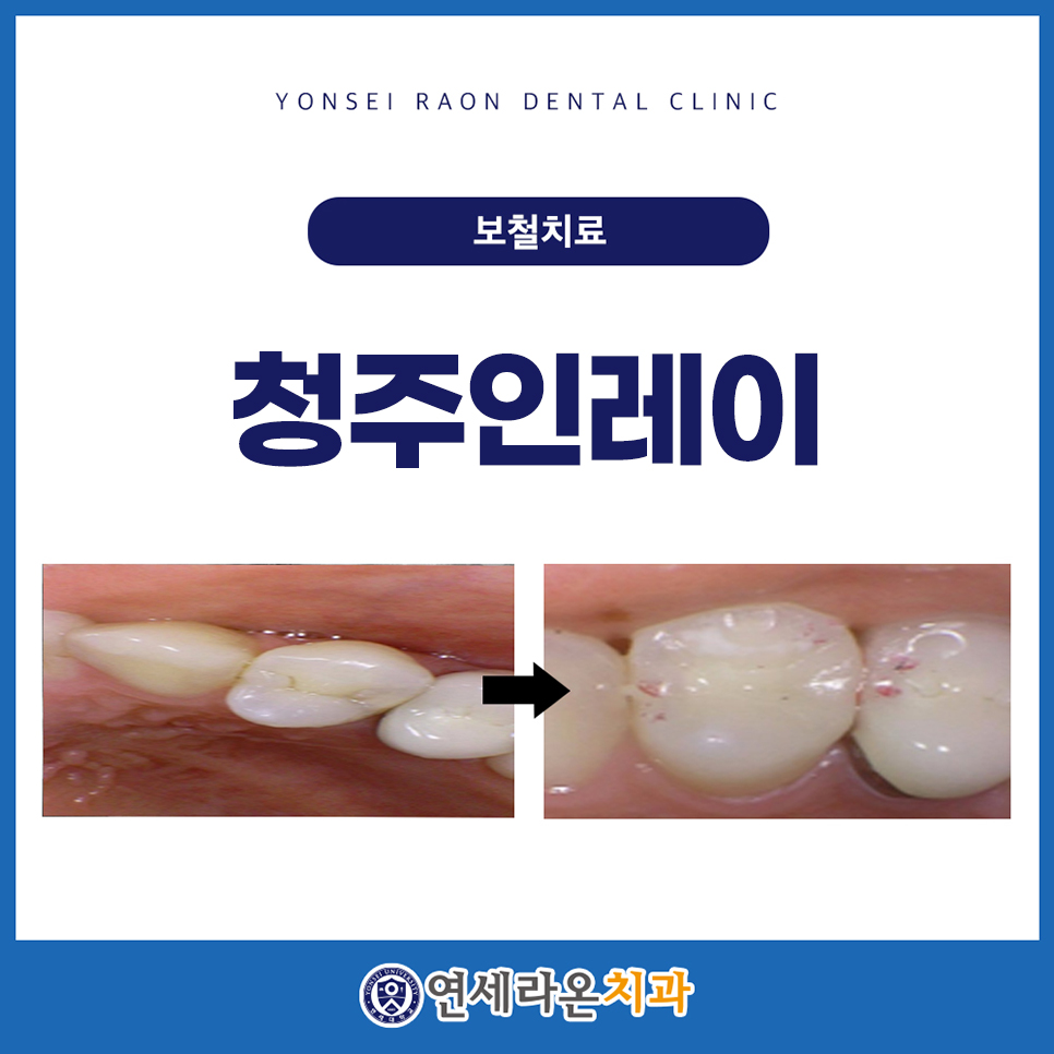 청주인레이 