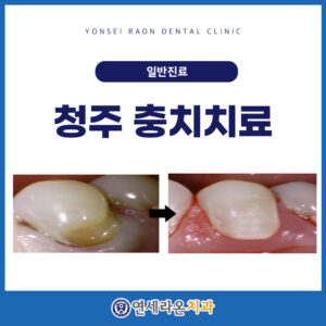 청주충치치료