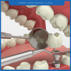 청주터미널치과 치료 진행